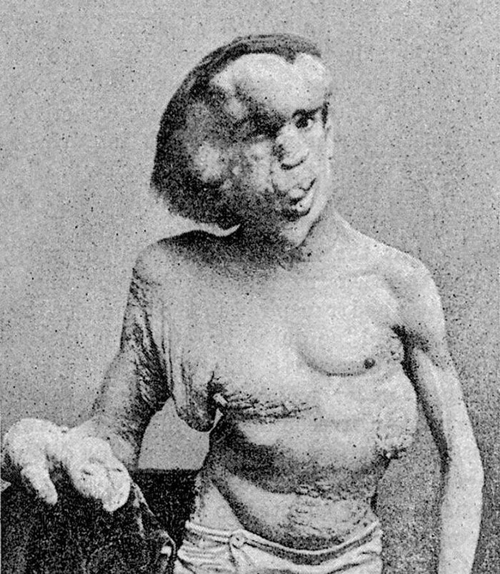 Joseph Merrick