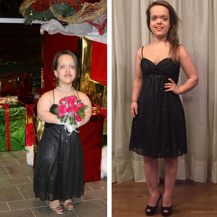before and after limb lengthening surgery chandler crews